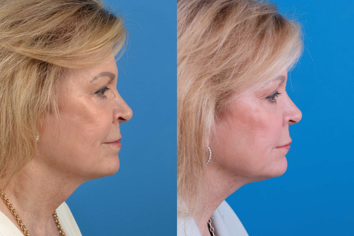 Profile Neck Lift Before & After Gallery - Patient 122406582 - Image 3