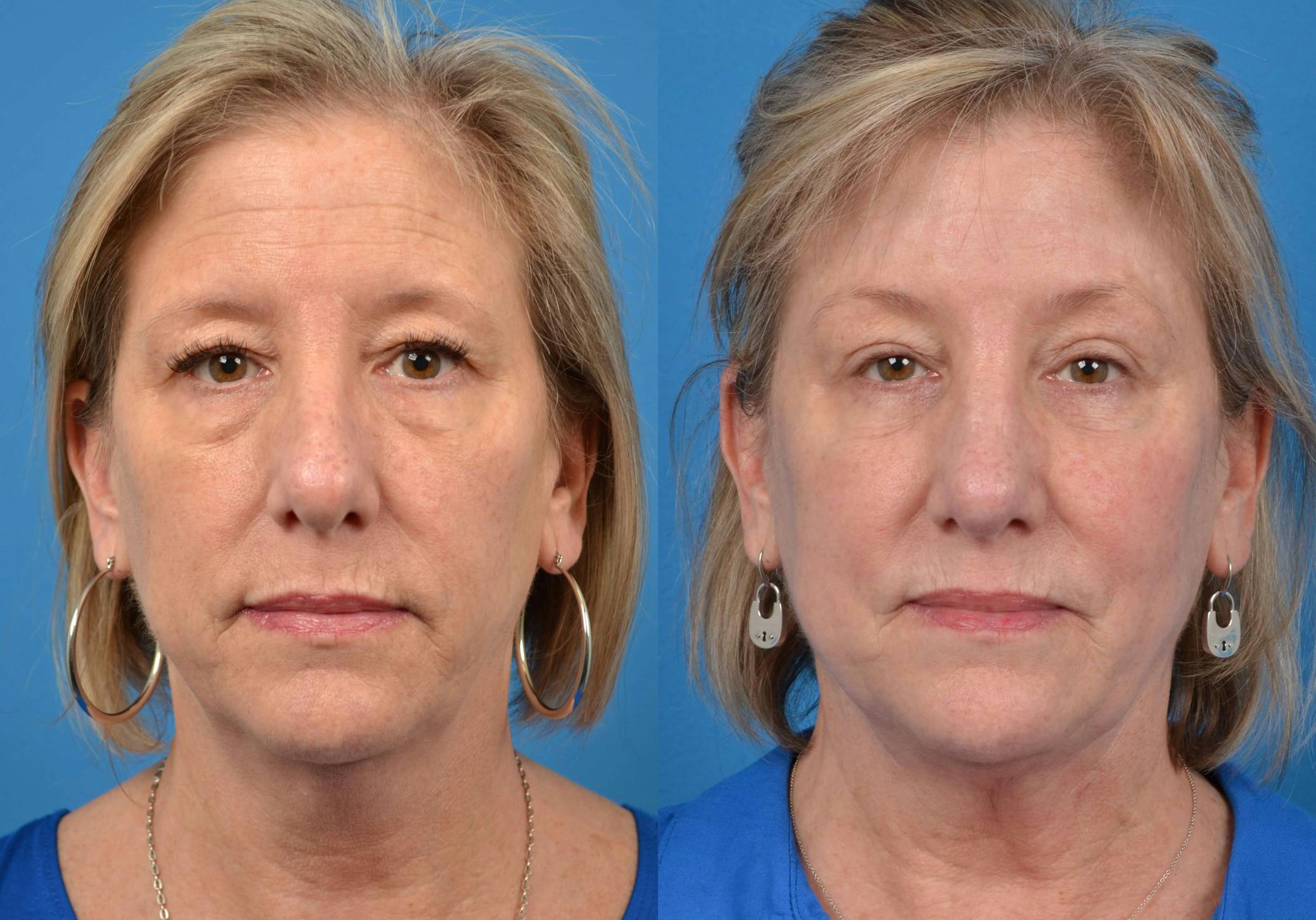 Laser Skin Resurfacing