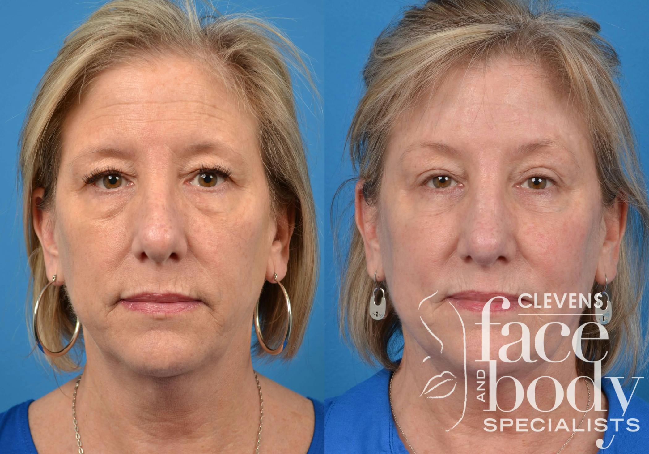 Laser Skin Resurfacing