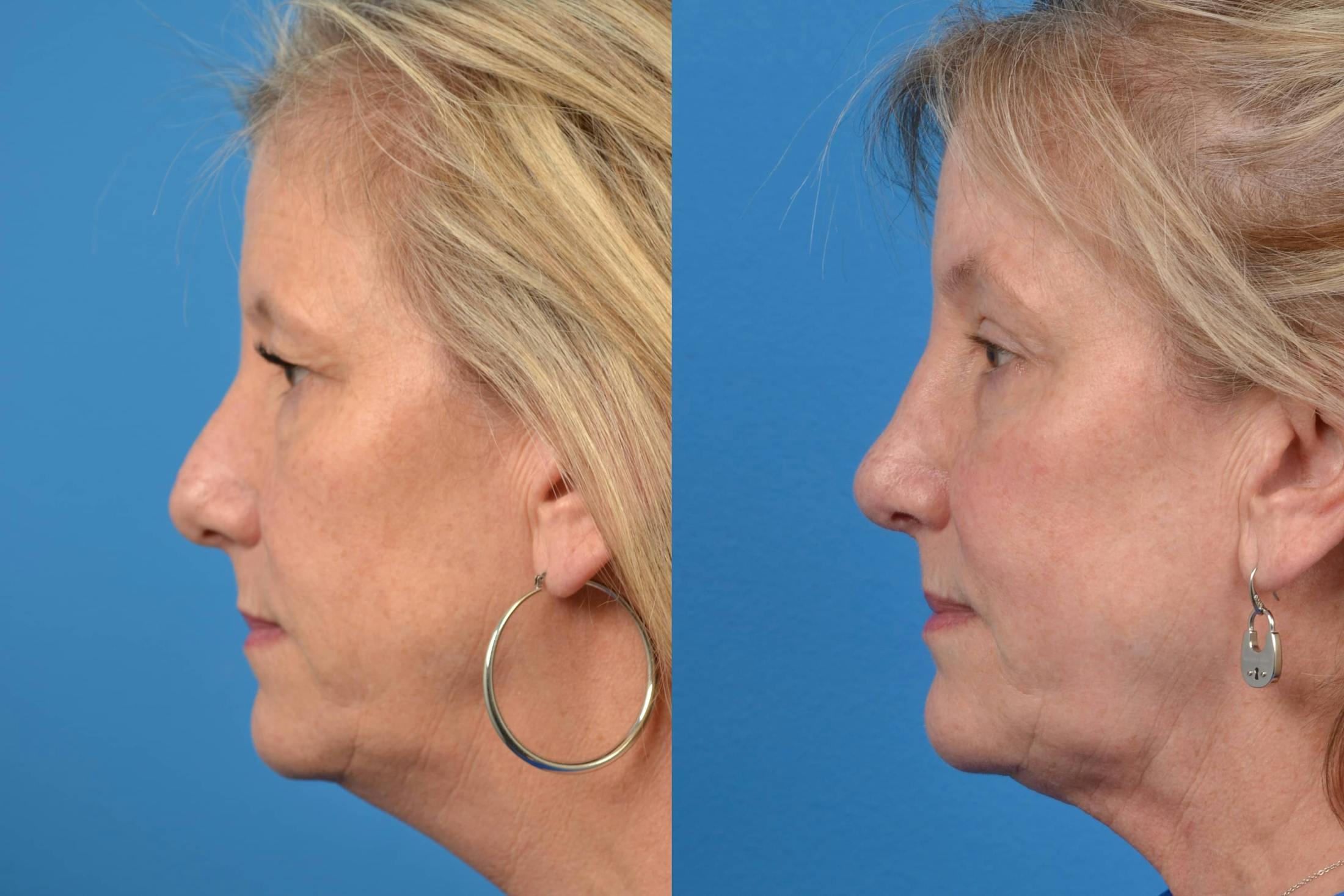 Skin Resurfacing Before & After Gallery - Patient 122406584 - Image 2