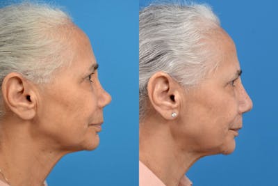 Rhinoplasty Before & After Gallery - Patient 122406586 - Image 1