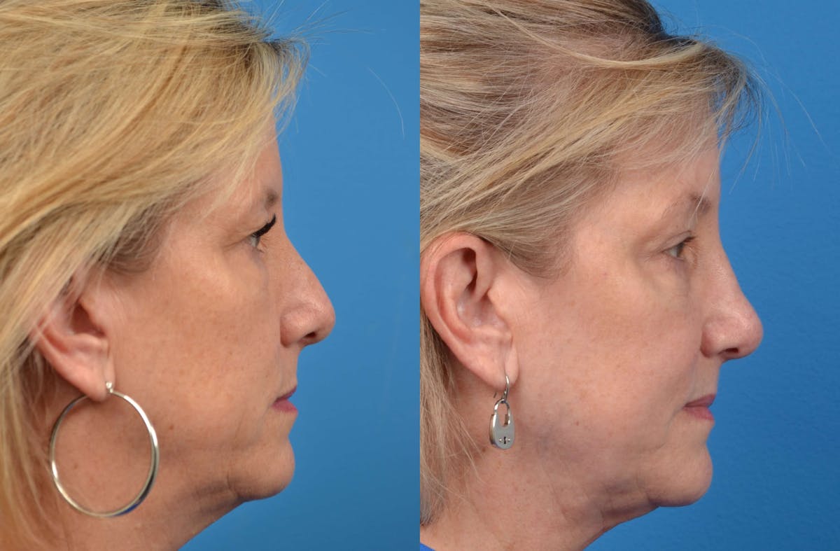 Skin Resurfacing Before & After Gallery - Patient 122406584 - Image 5