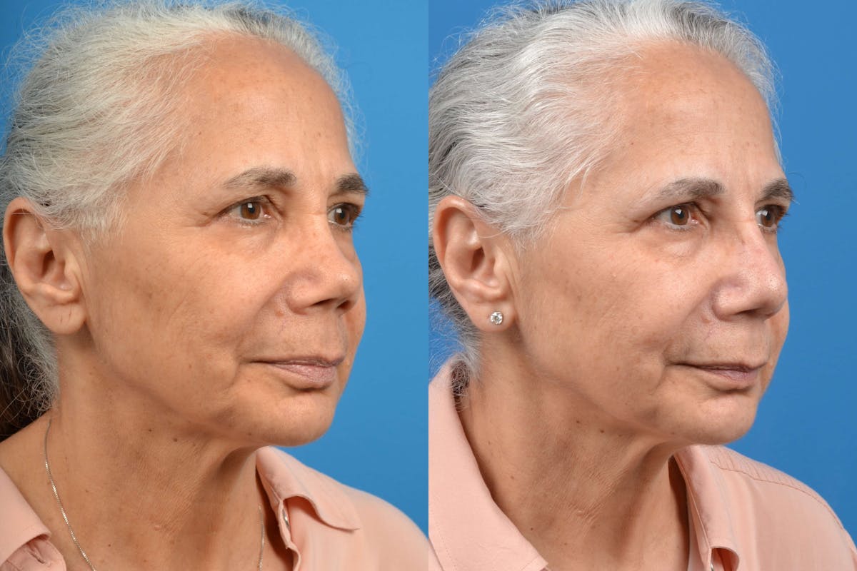 Rhinoplasty Before & After Gallery - Patient 122406586 - Image 2