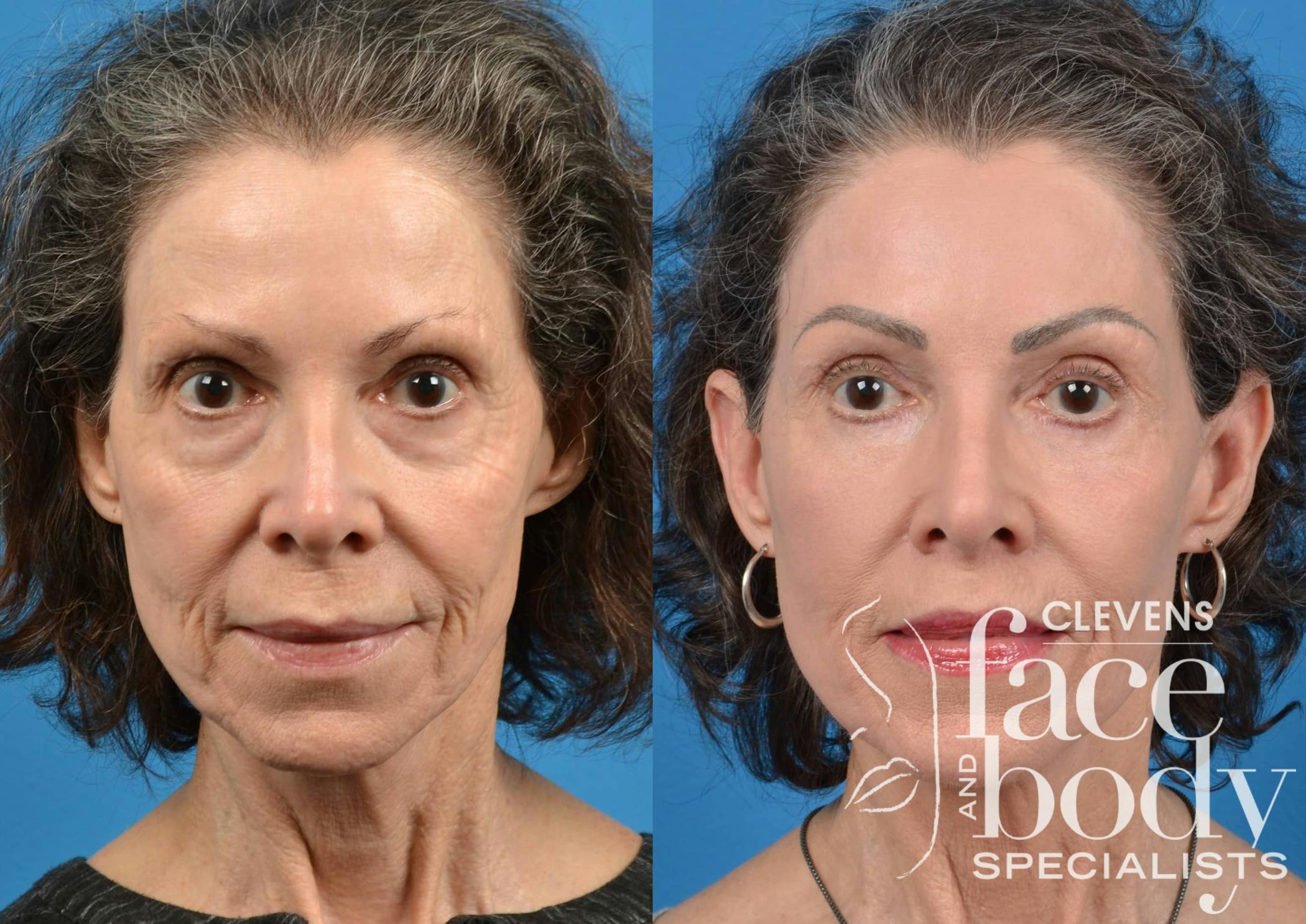 Laser Skin Resurfacing