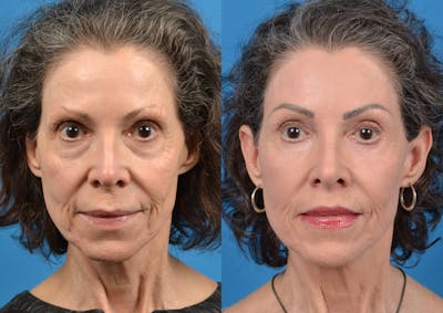 Skin Resurfacing Before & After Gallery - Patient 122406585 - Image 1