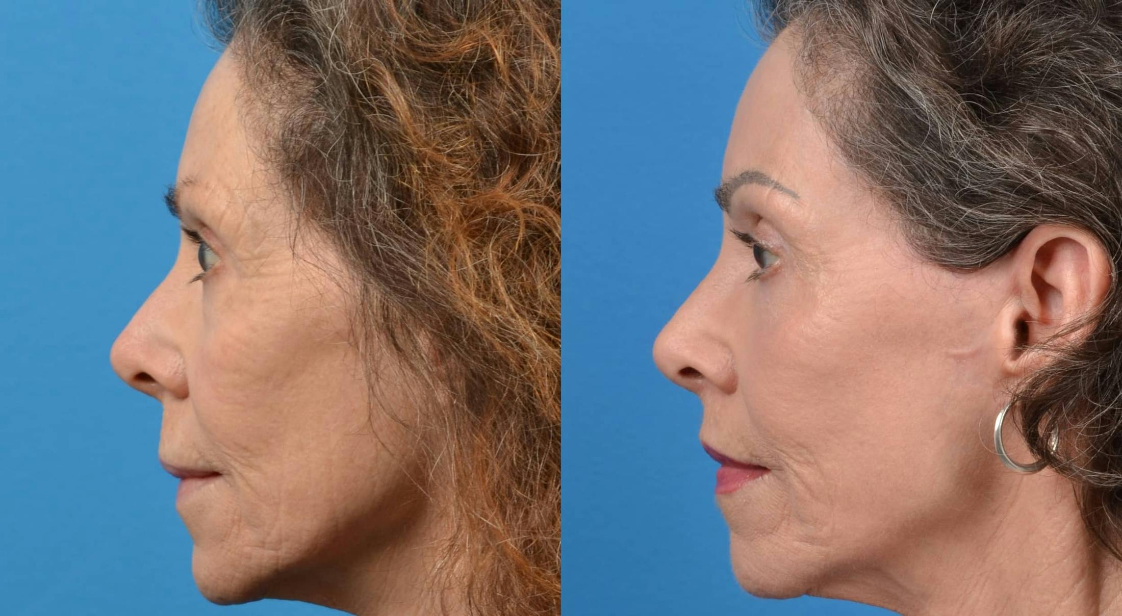 Skin Resurfacing Before & After Gallery - Patient 122406585 - Image 2