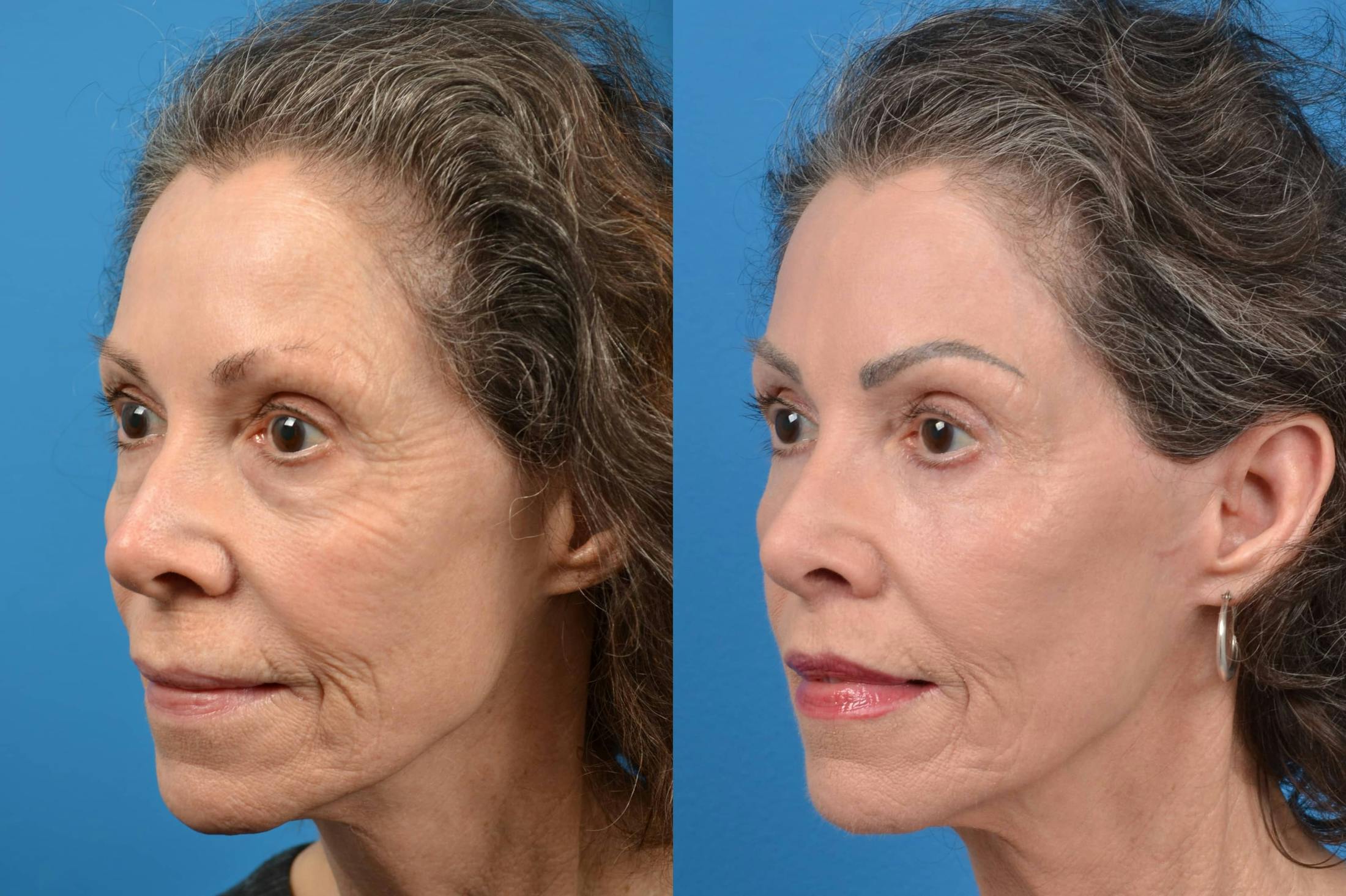 Skin Resurfacing Before & After Gallery - Patient 122406585 - Image 3