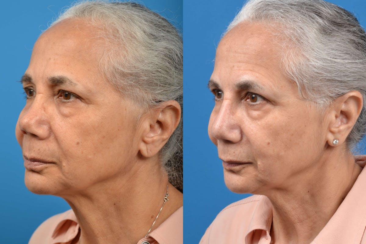 Rhinoplasty Before & After Gallery - Patient 122406586 - Image 4