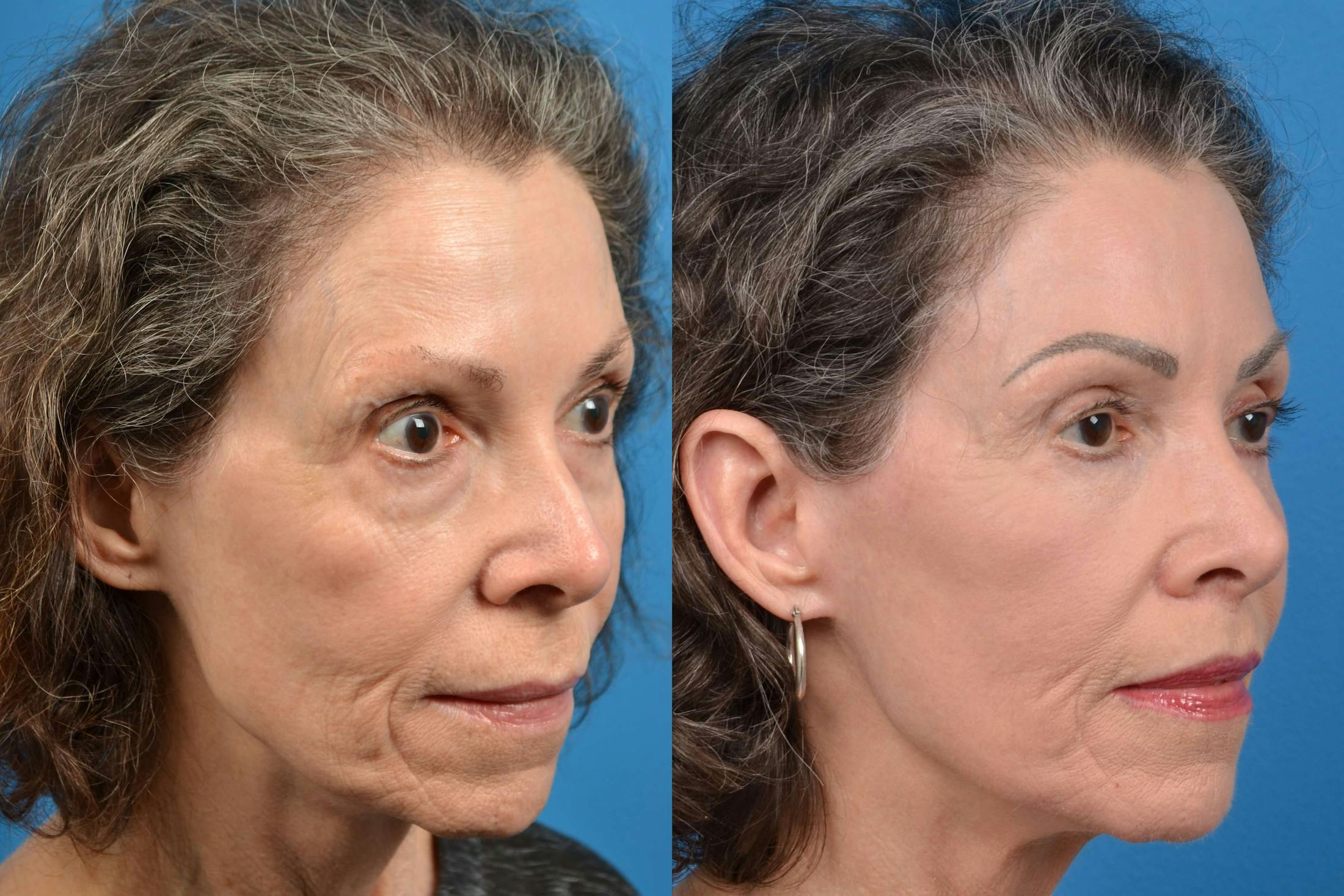 Skin Resurfacing Before & After Gallery - Patient 122406585 - Image 4