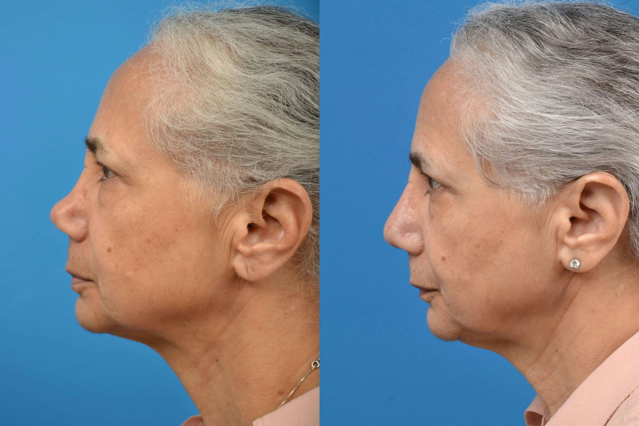 Rhinoplasty Before & After Gallery - Patient 122406586 - Image 5