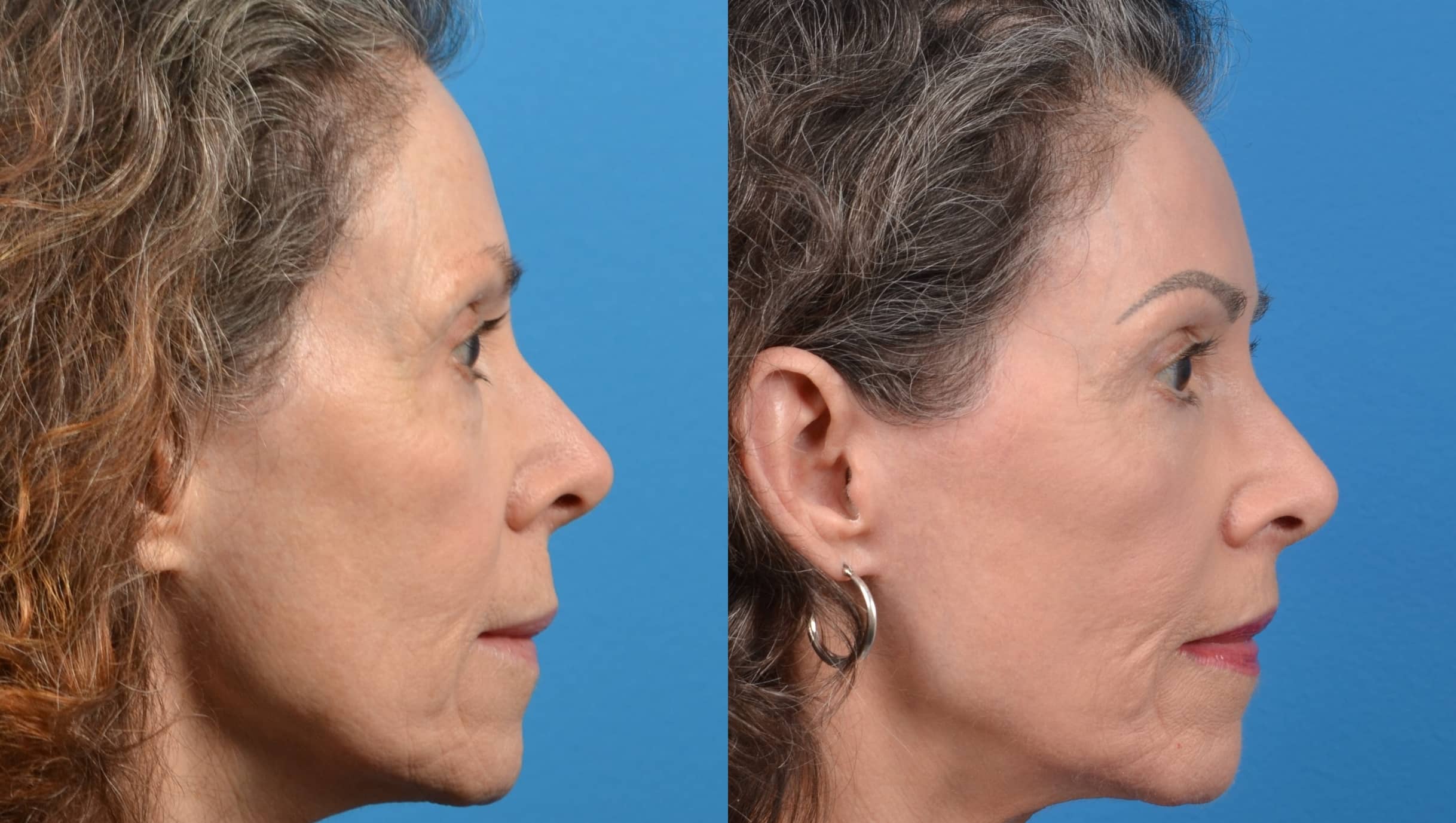 Skin Resurfacing Before & After Gallery - Patient 122406585 - Image 5