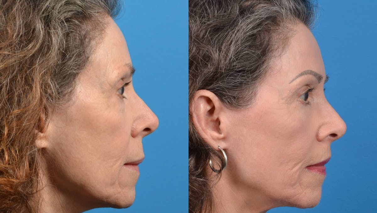 Skin Resurfacing Before & After Gallery - Patient 122406585 - Image 5