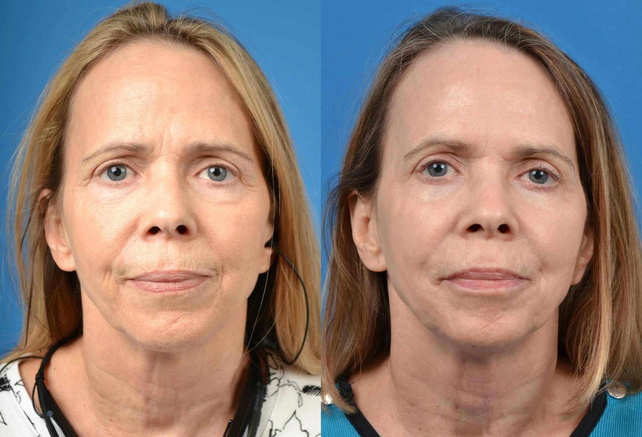 Skin Resurfacing Before & After Gallery - Patient 122406588 - Image 1