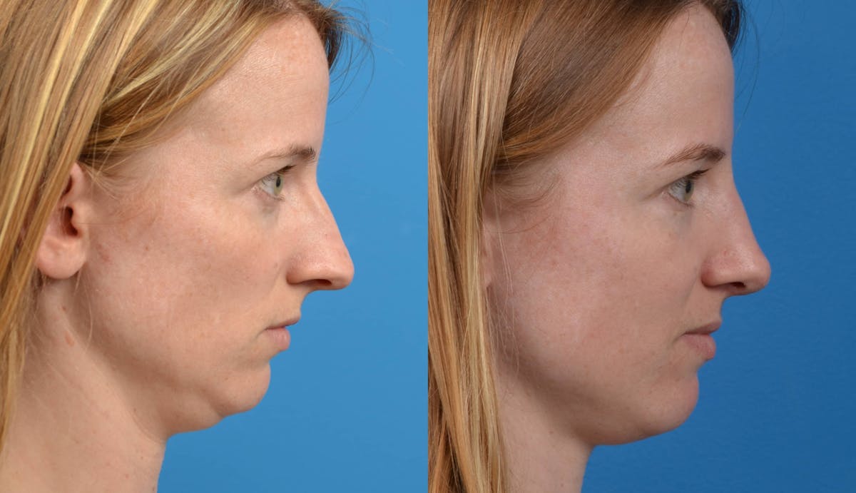 Rhinoplasty Before & After Gallery - Patient 122406594 - Image 1