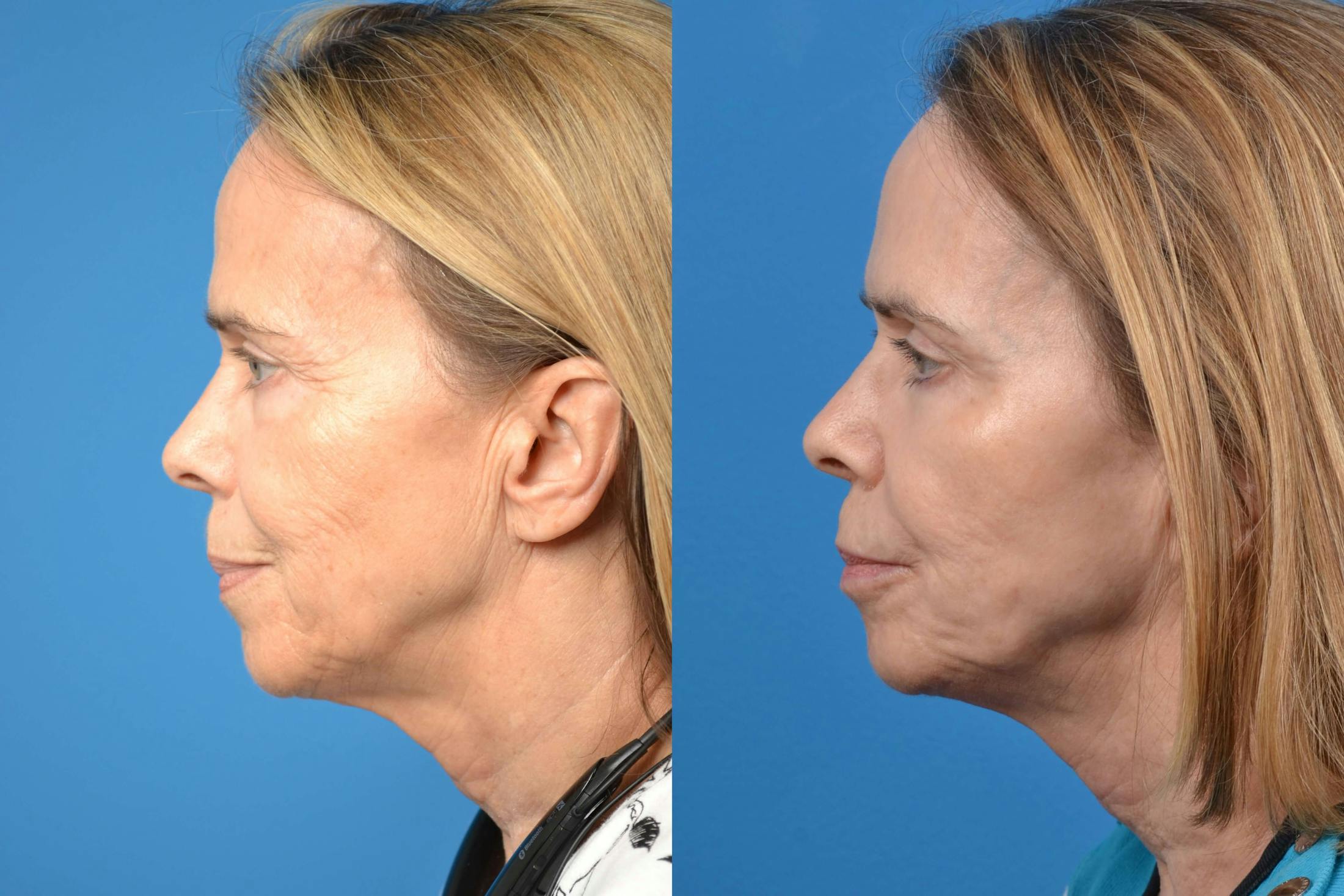 Skin Resurfacing Before & After Gallery - Patient 122406588 - Image 2