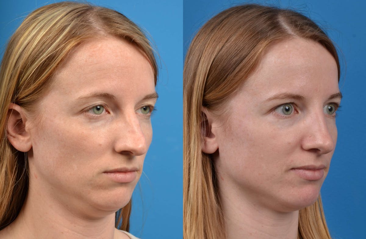 Rhinoplasty Before & After Gallery - Patient 122406594 - Image 2