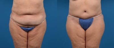 Tummy Tuck Before & After Gallery - Patient 122406587 - Image 1