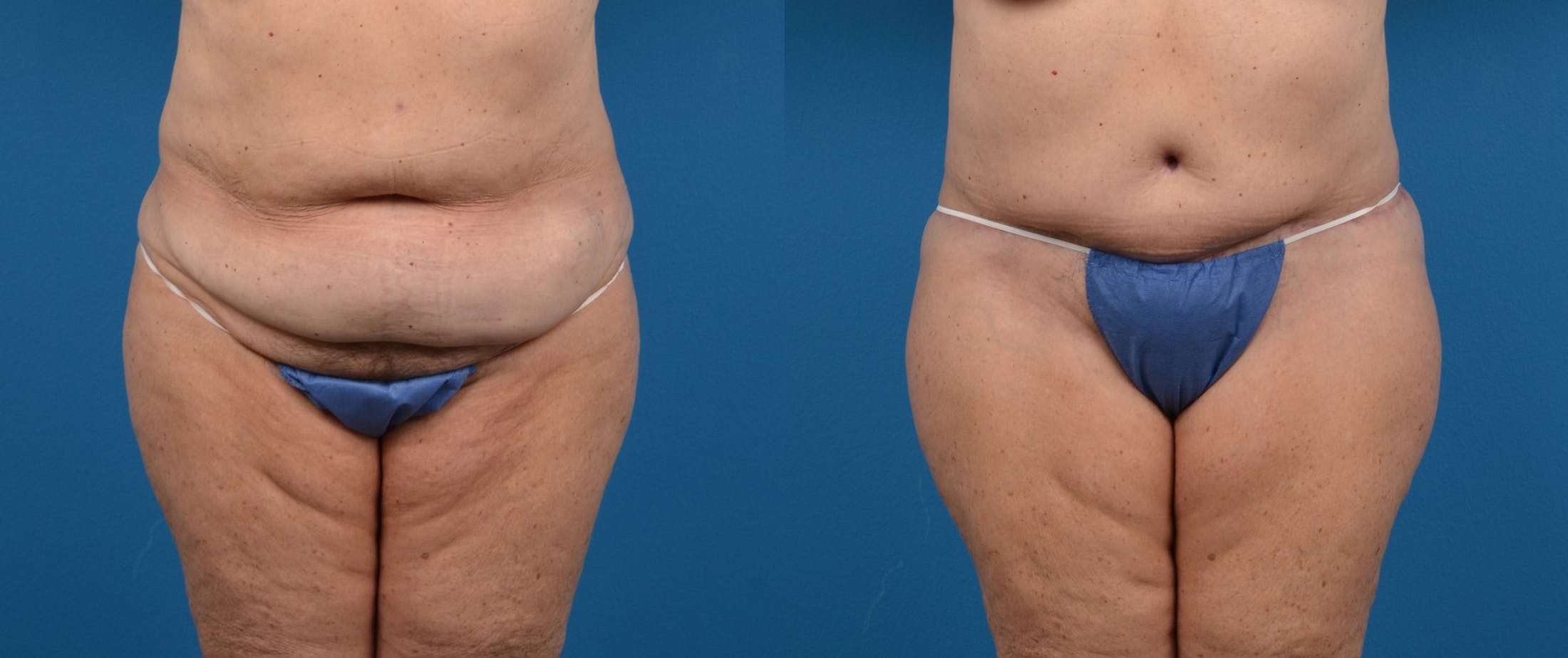 Tummy Tuck Before & After Gallery - Patient 122406587 - Image 1