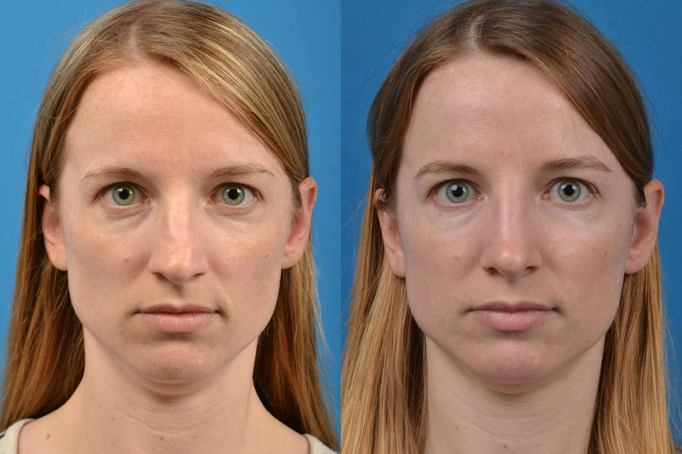 Rhinoplasty Before & After Gallery - Patient 122406594 - Image 3