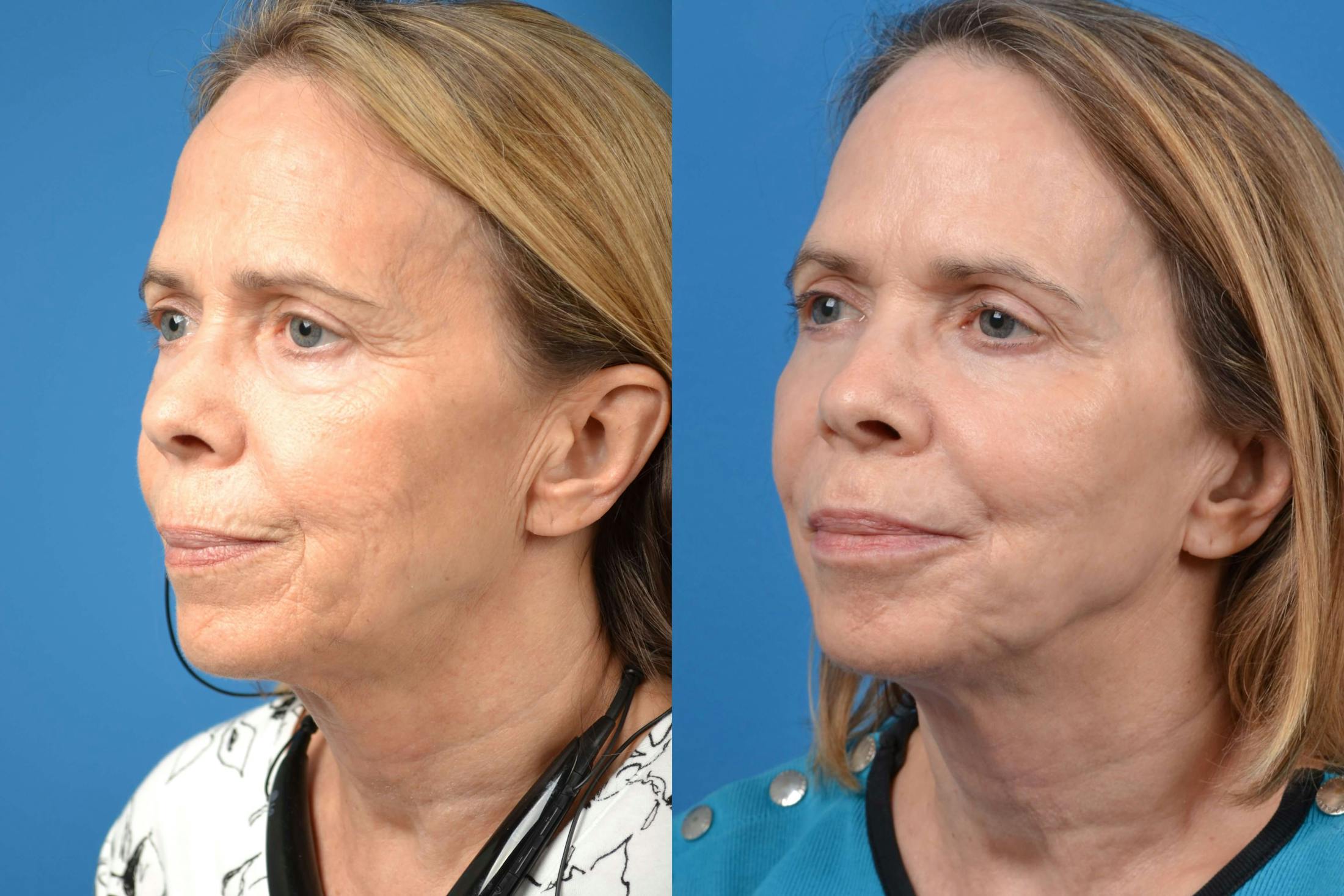 Skin Resurfacing Before & After Gallery - Patient 122406588 - Image 3