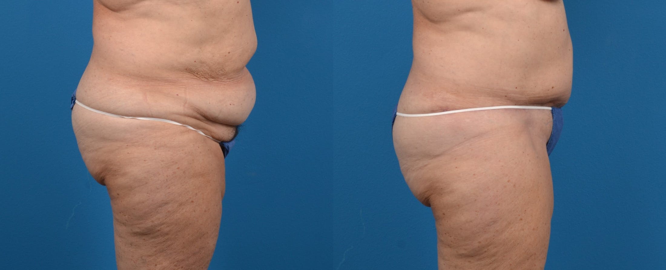 Tummy Tuck Before & After Gallery - Patient 122406587 - Image 2