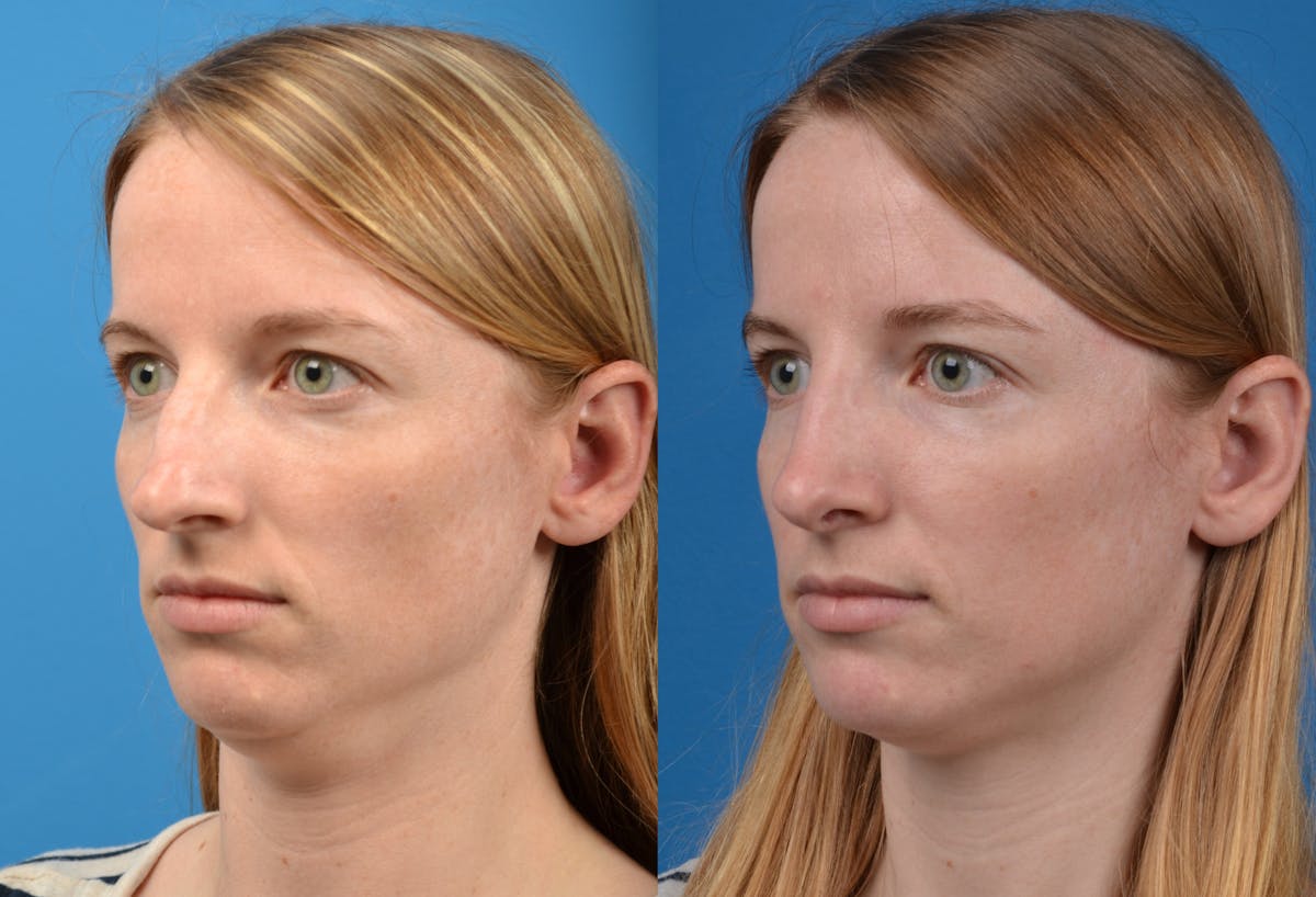 Rhinoplasty Before & After Gallery - Patient 122406594 - Image 4