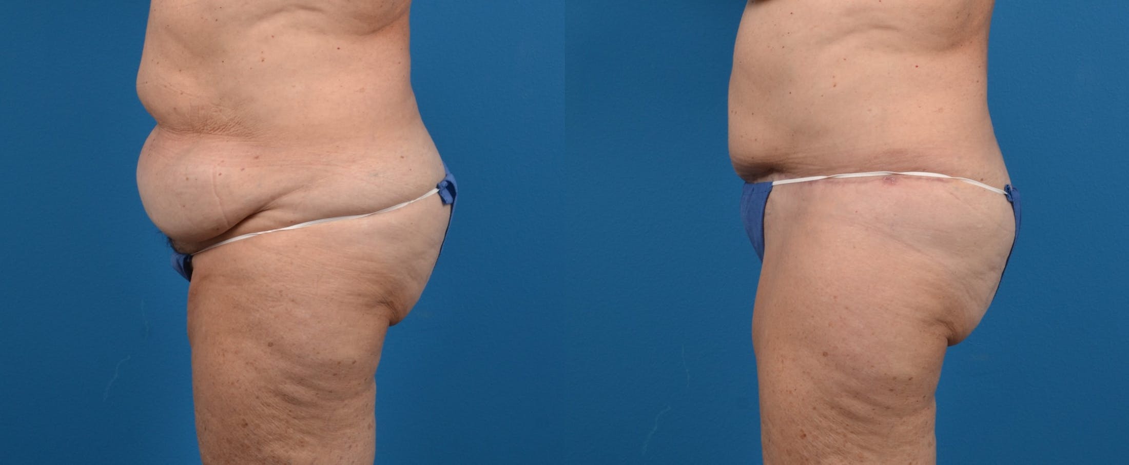 Tummy Tuck Before & After Gallery - Patient 122406587 - Image 3