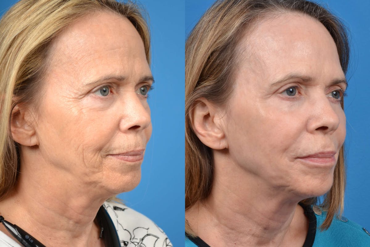 Skin Resurfacing Before & After Gallery - Patient 122406588 - Image 4