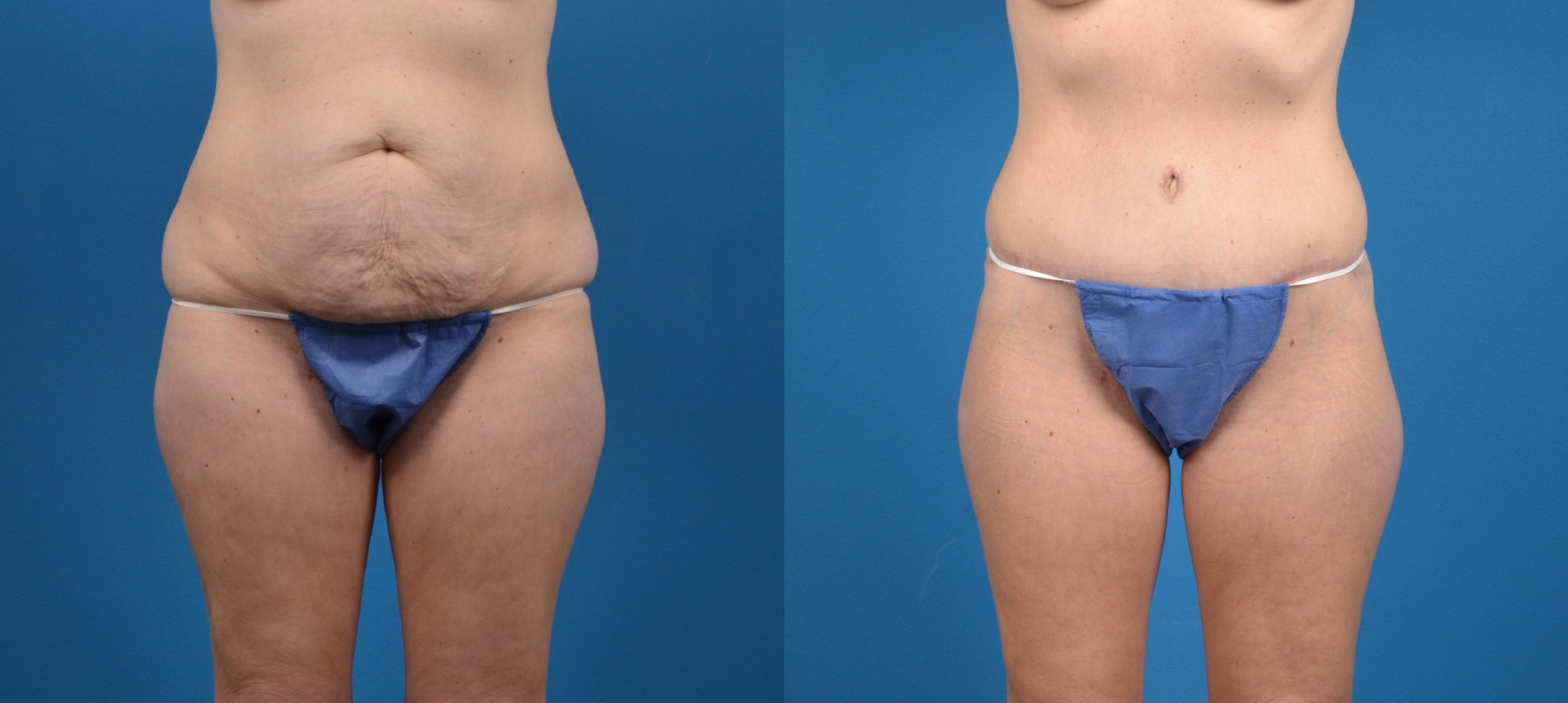 Hidden Tummy Tuck Before & After Gallery - Patient 227115 - Image 1