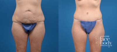 Hidden Tummy Tuck Before & After Gallery - Patient 227115 - Image 1