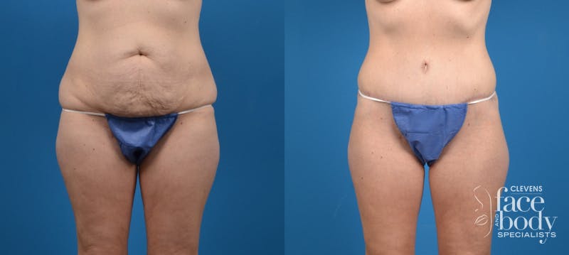 Hidden Tummy Tuck Before & After Gallery - Patient 287004 - Image 1