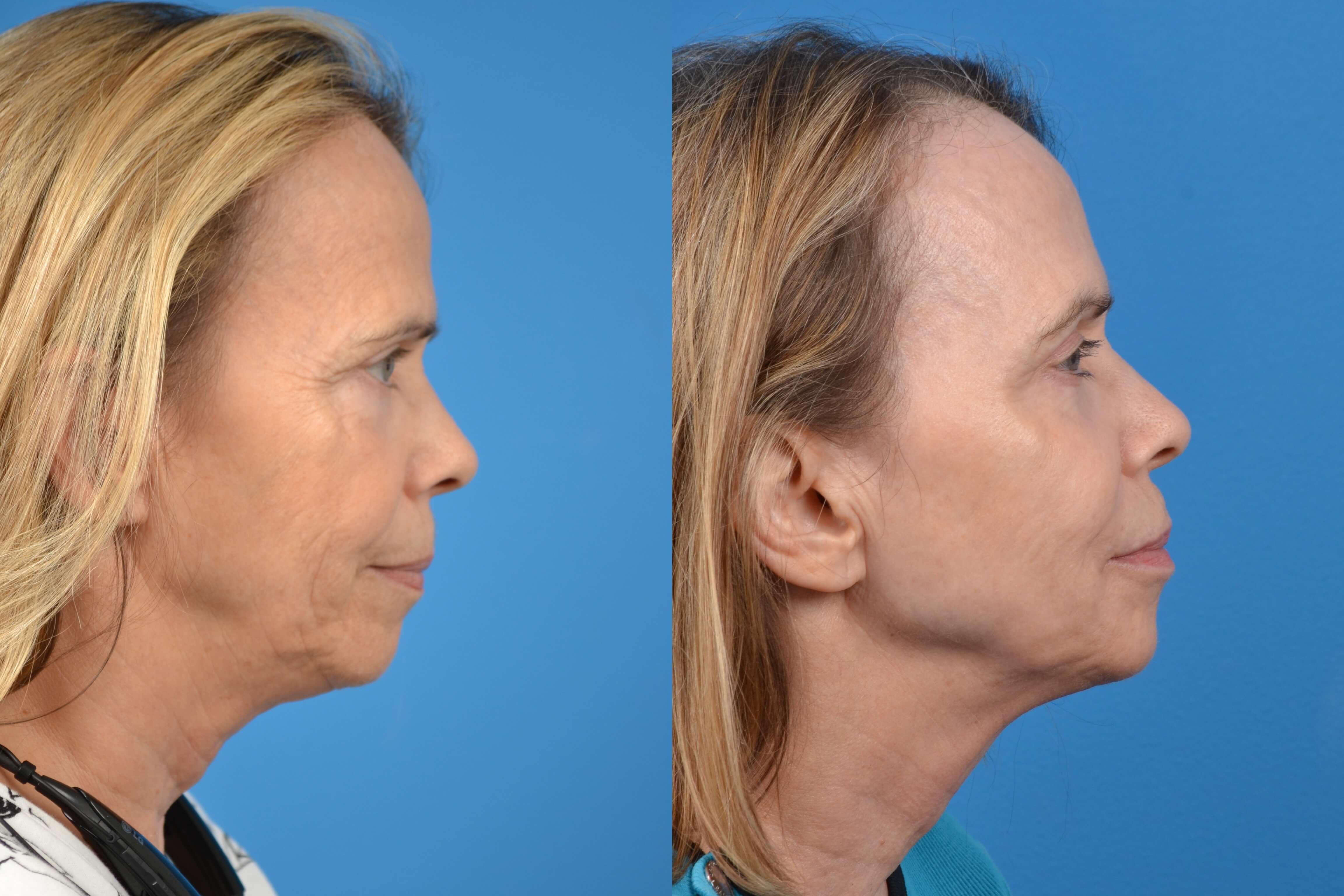 Skin Resurfacing Before & After Gallery - Patient 122406588 - Image 5