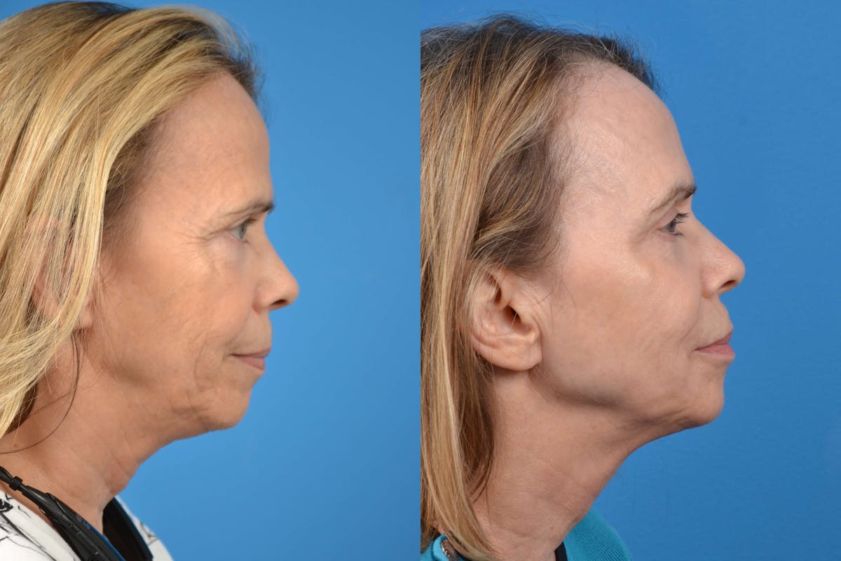 Skin Resurfacing Before & After Gallery - Patient 122406588 - Image 5