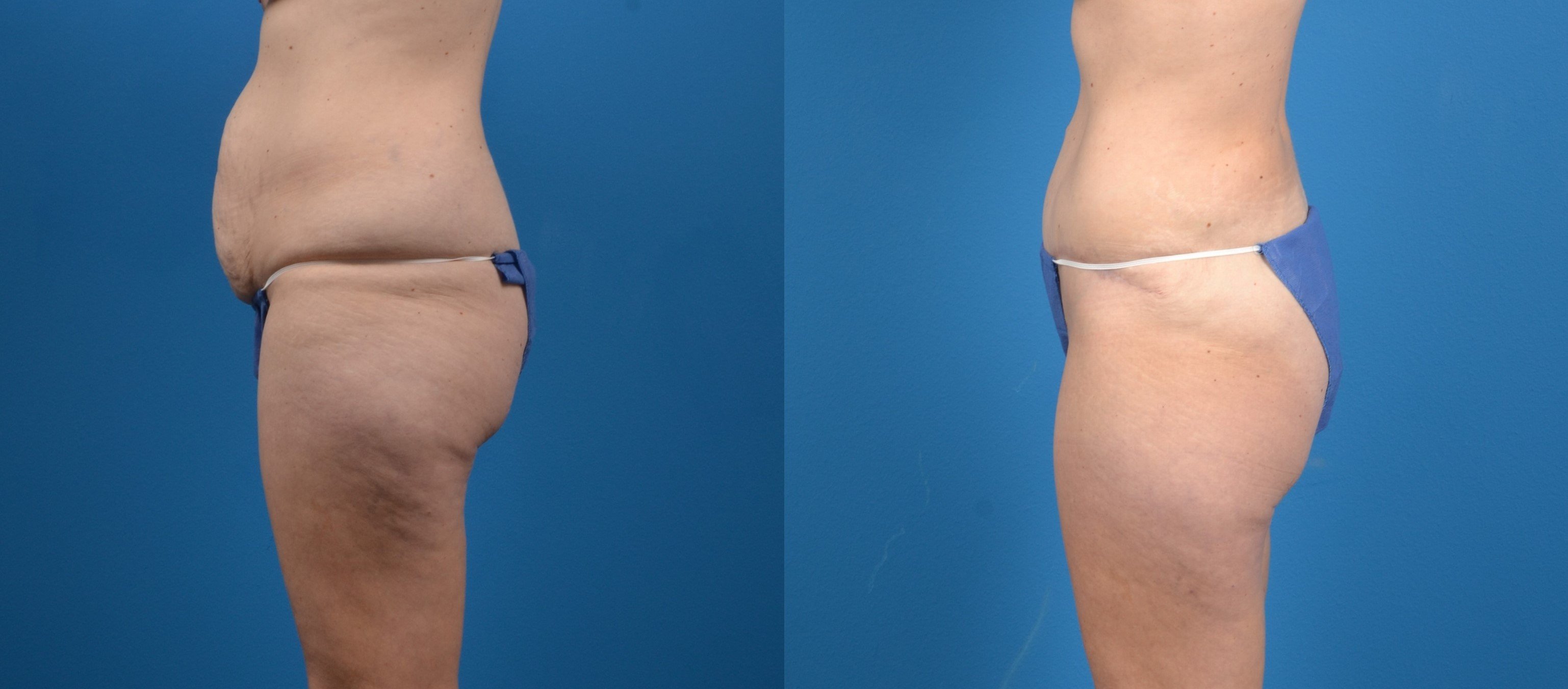 Hidden Tummy Tuck Before & After Gallery - Patient 227115 - Image 2