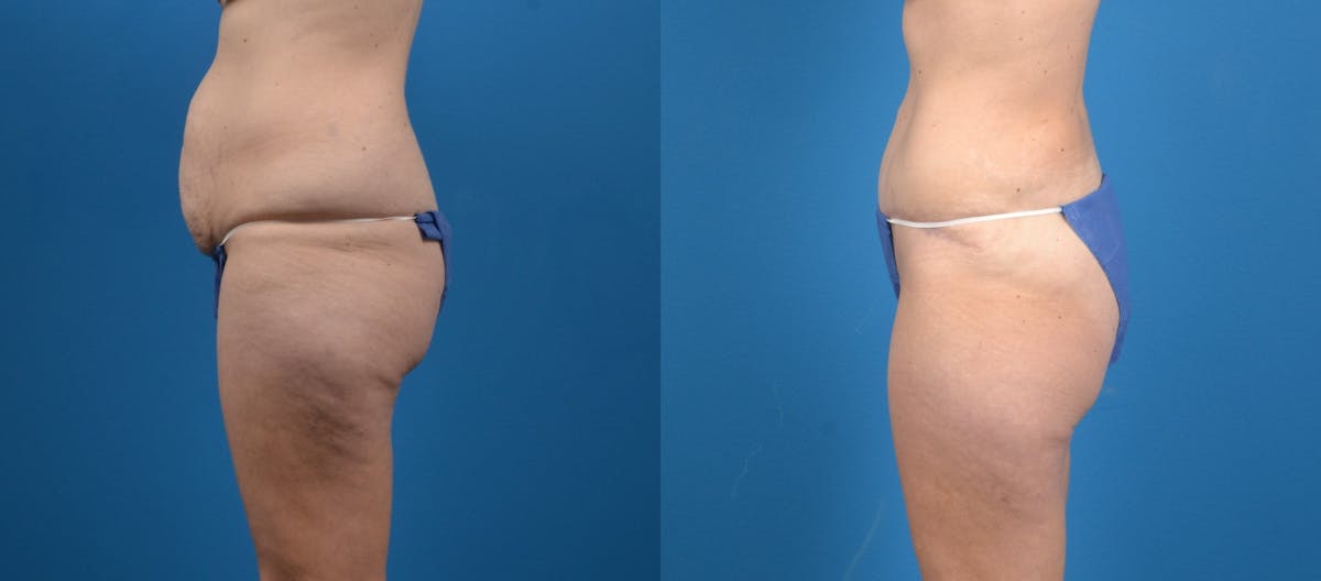 Tummy Tuck Before & After Gallery - Patient 313406 - Image 2