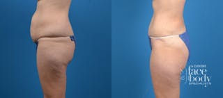 Hidden Tummy Tuck Before & After Gallery - Patient 287004 - Image 2