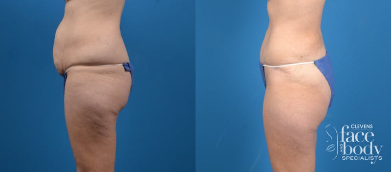 Hidden Tummy Tuck Before & After Gallery - Patient 287004 - Image 2