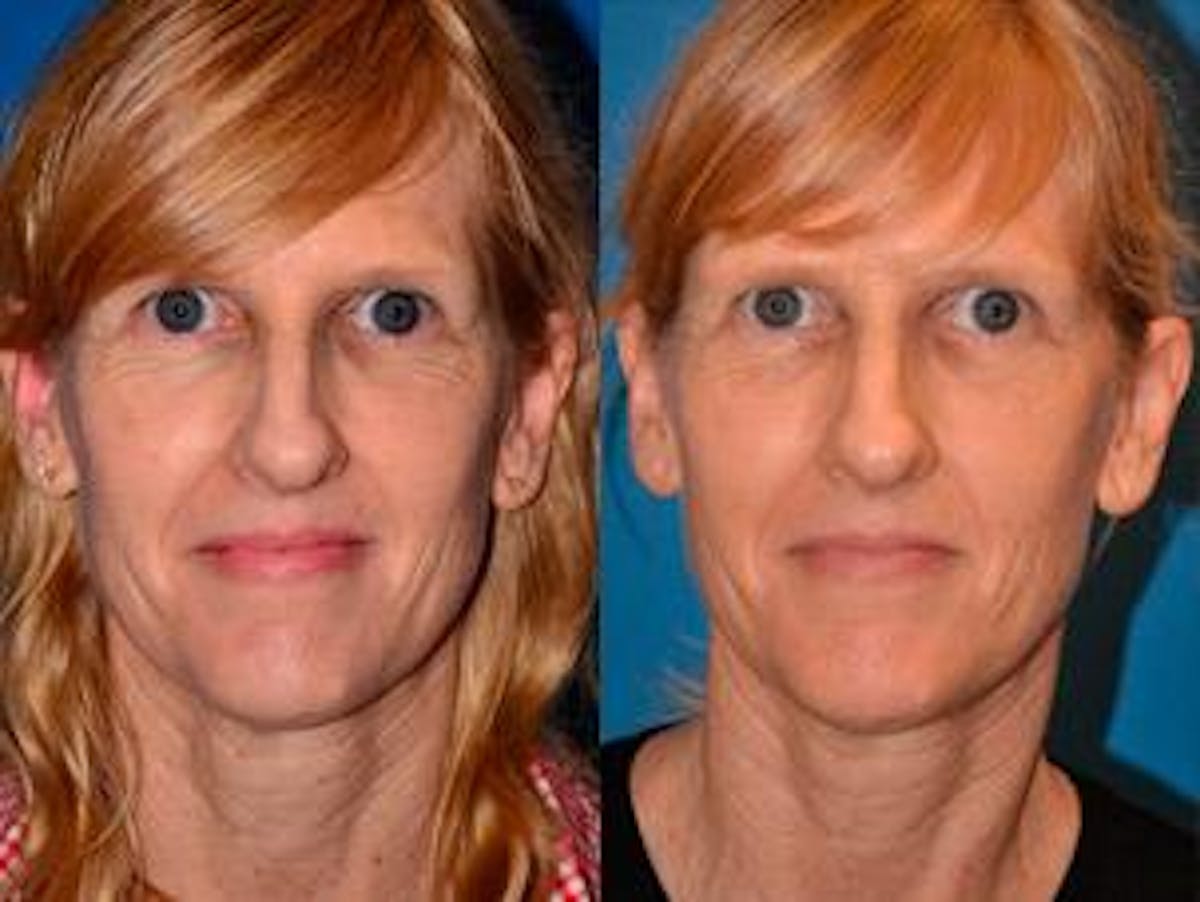 Skin Resurfacing Before & After Gallery - Patient 122406589 - Image 1
