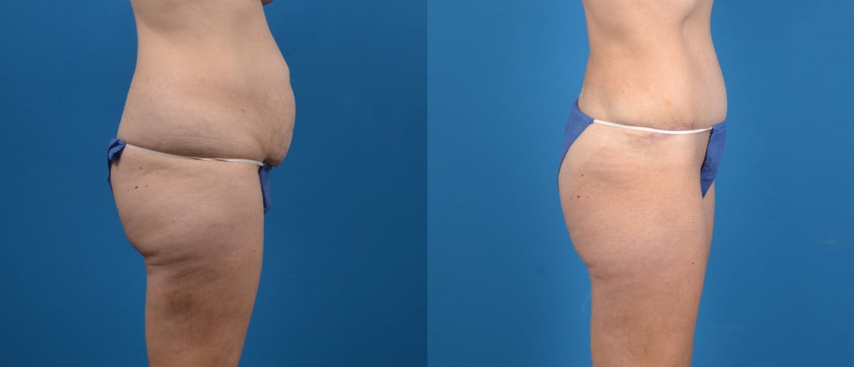 Tummy Tuck Before & After Gallery - Patient 313406 - Image 3