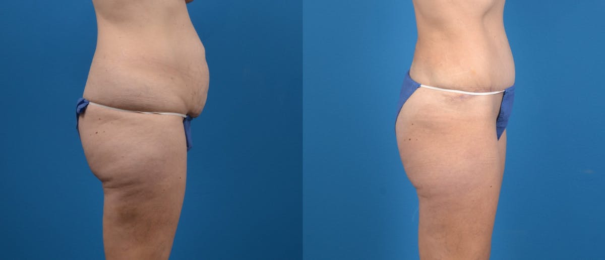 Hidden Tummy Tuck Before & After Gallery - Patient 287004 - Image 3