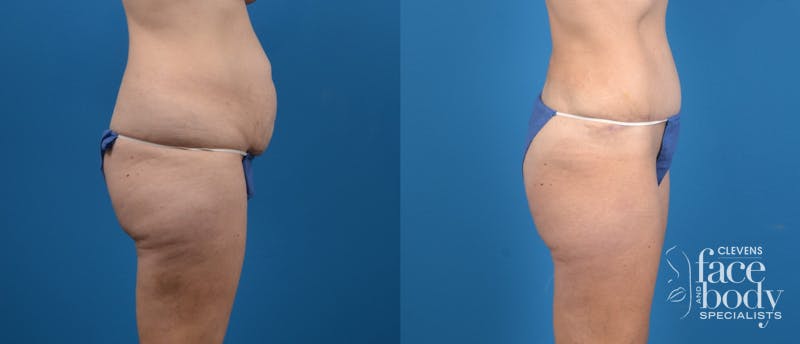 Hidden Tummy Tuck Before & After Gallery - Patient 287004 - Image 3