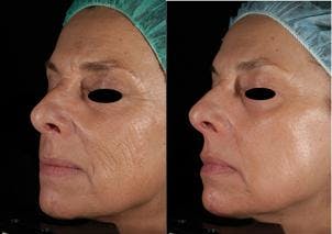Skin Resurfacing Before & After Gallery - Patient 122406591 - Image 1