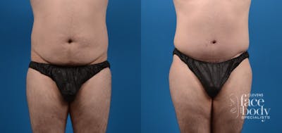 Hidden Tummy Tuck Before & After Gallery - Patient 320139 - Image 1