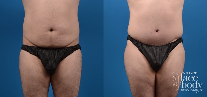 Hidden Tummy Tuck Before & After Gallery - Patient 198245 - Image 1
