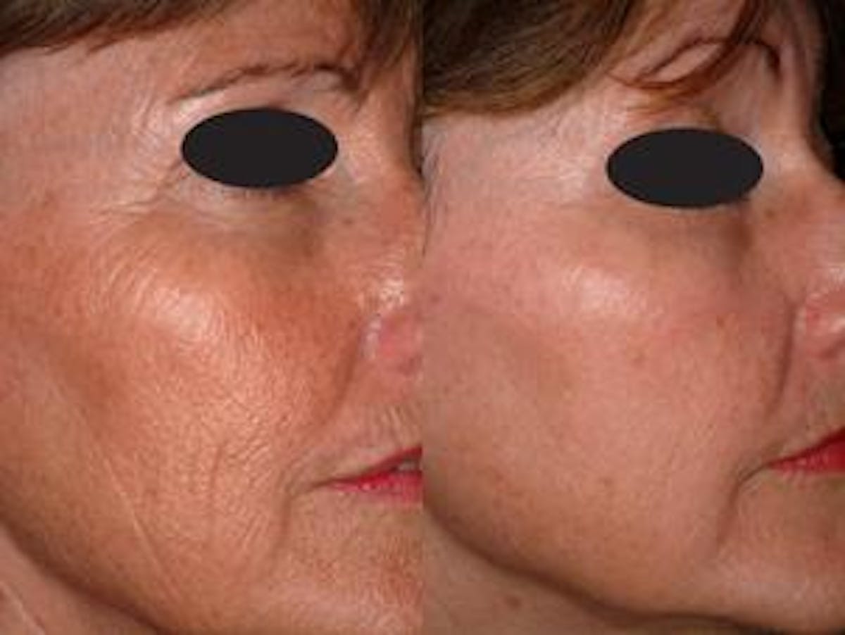 Skin Resurfacing Before & After Gallery - Patient 122406592 - Image 1