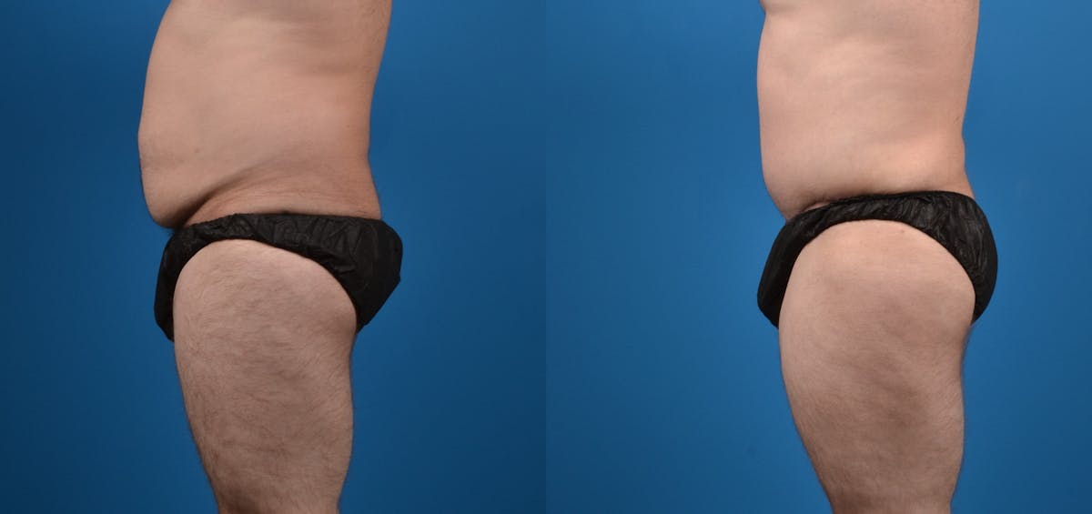Hidden Tummy Tuck Before & After Gallery - Patient 198245 - Image 2