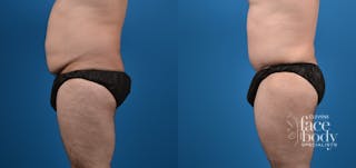 Hidden Tummy Tuck Before & After Gallery - Patient 198245 - Image 2