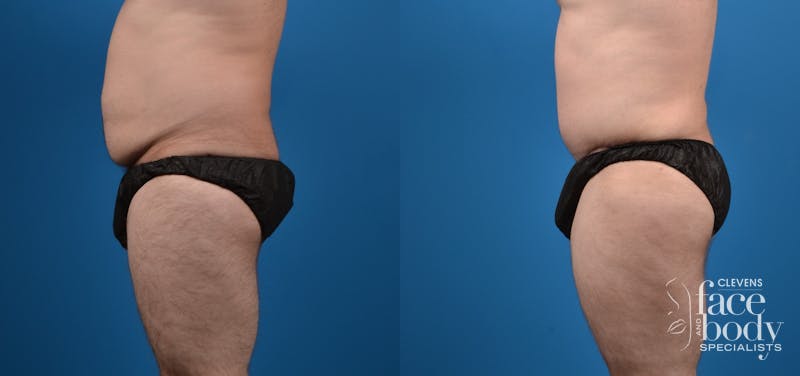 Hidden Tummy Tuck Before & After Gallery - Patient 198245 - Image 2