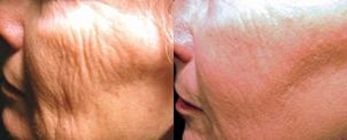 Skin Resurfacing Before & After Gallery - Patient 122406593 - Image 1
