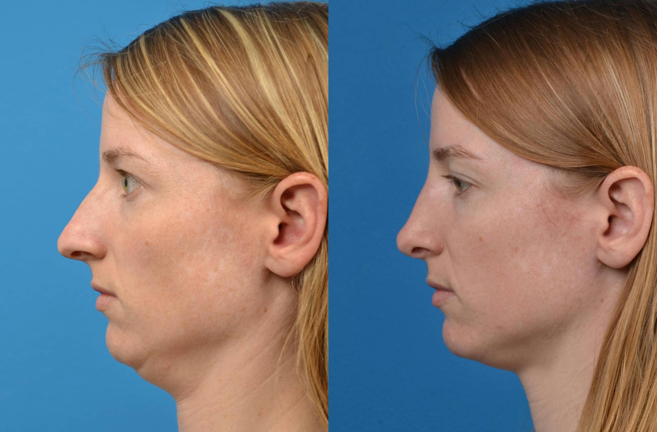 Rhinoplasty Before & After Gallery - Patient 122406594 - Image 5